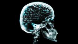 Gehirn: Die Heilmittelforschung bei Alzheimer läuft auf Hochtouren. Getty Images