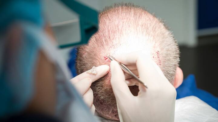 Haartransplantation
