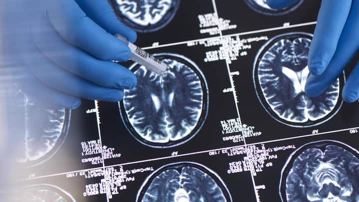 <p>4 bis 6 Milliarden Dollar kostet es, eine neue Therapie zu entwickeln: Daten zu einer neurologischen Studie.</p>