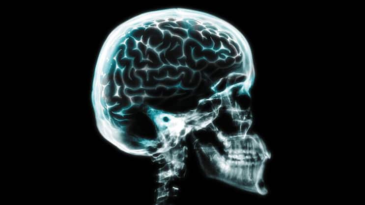 Gehirn: Die Heilmittelforschung bei Alzheimer läuft auf Hochtouren. Getty Images