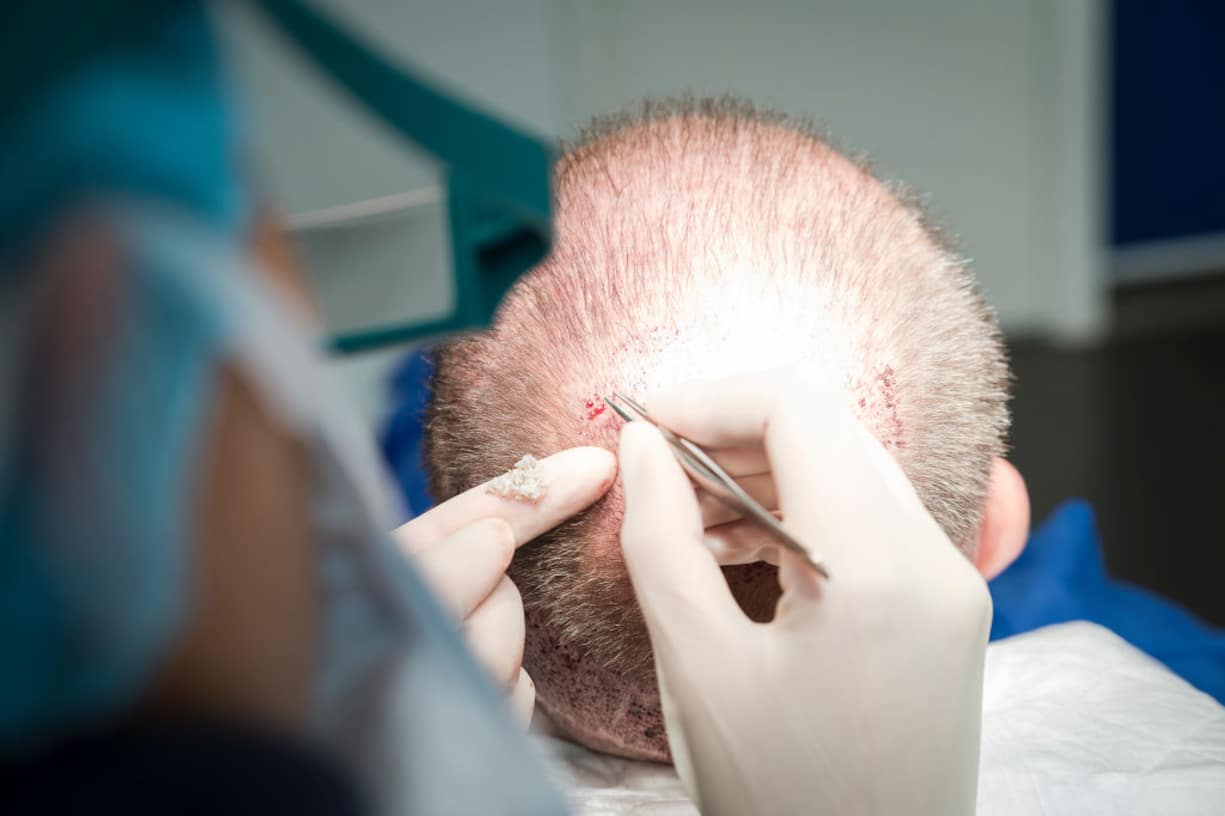 Haartransplantation