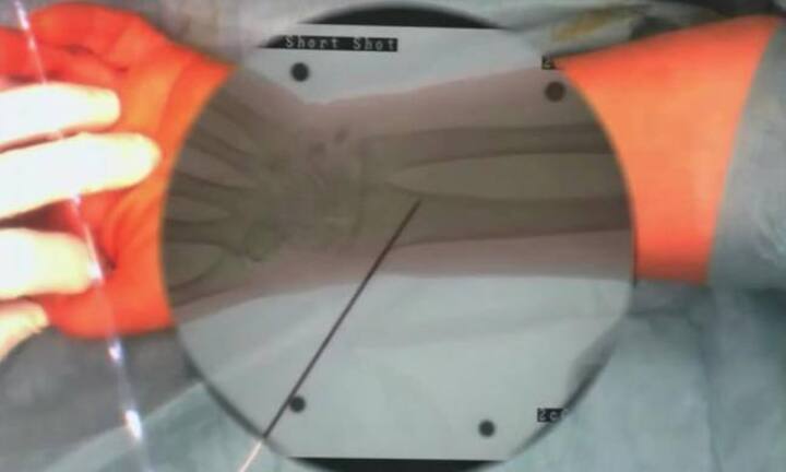 Ärzte profitieren stark von sogenannter «Augmented Reality». In der Medizin gibt es beinahe unbegrenzte Anwendungsmöglichkeiten für die Technologie.
Youtube/ieeeComputerSociety